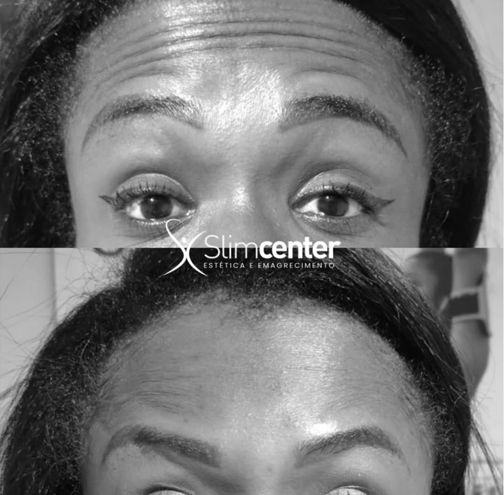 Antes e Depois Botox em Jundiaí Antes e Depois Botox em Jundiaí