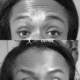 Antes e Depois Botox em Jundiaí