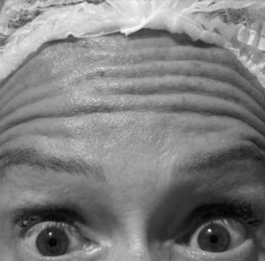 botox_antes