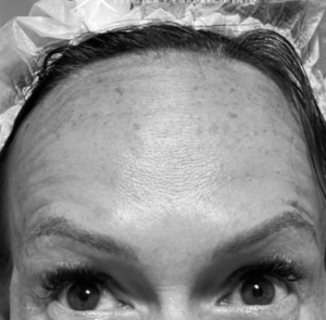 botox_depois