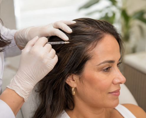 Profissional realizando mesoterapia capilar com aplicação no couro cabeludo.